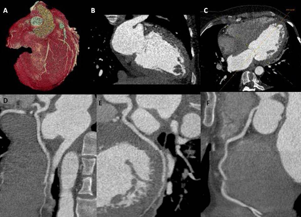 <p>Coronary Computed Tomography Angiography