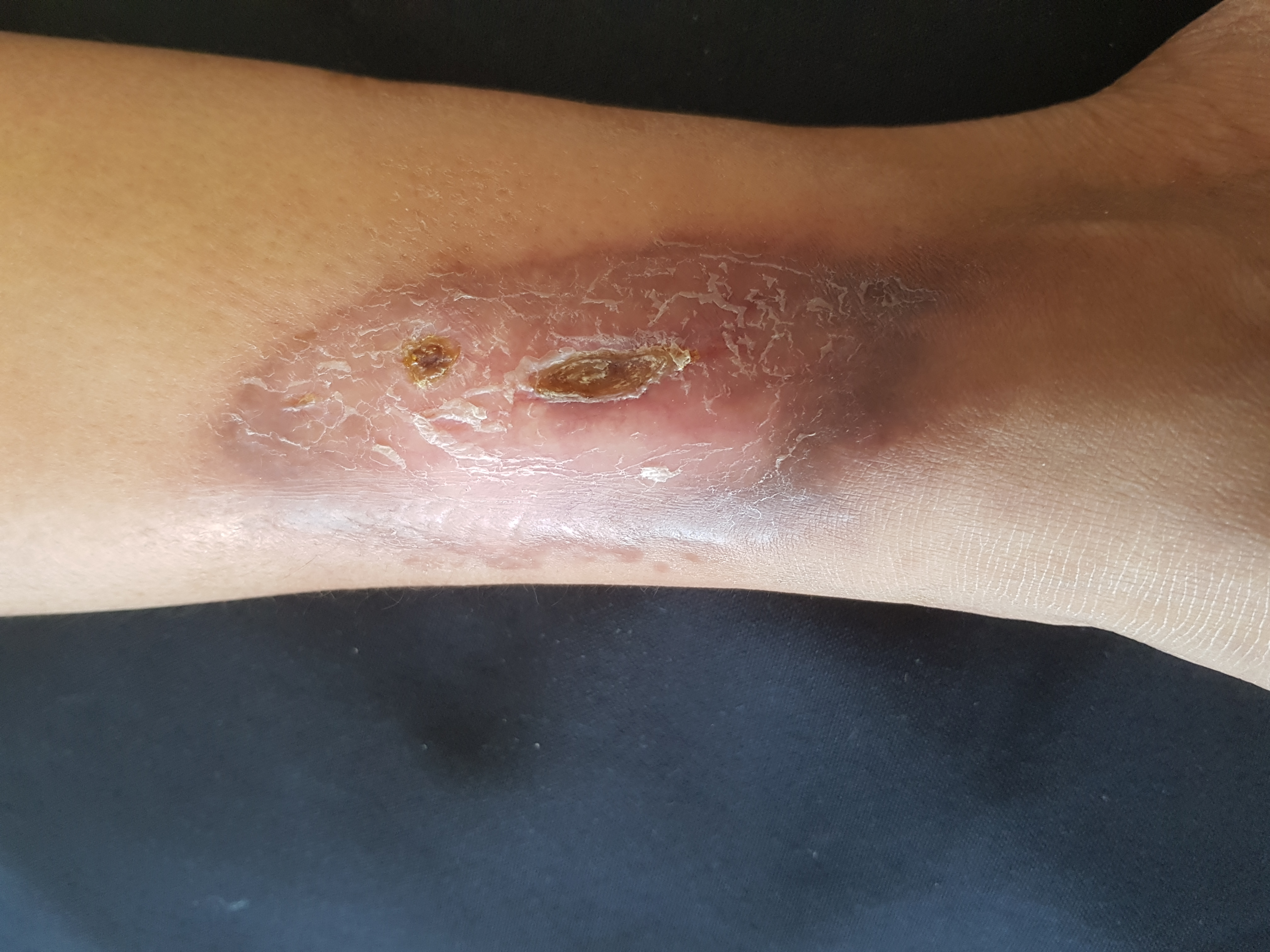 <p>Necrobiosis Lipoidica