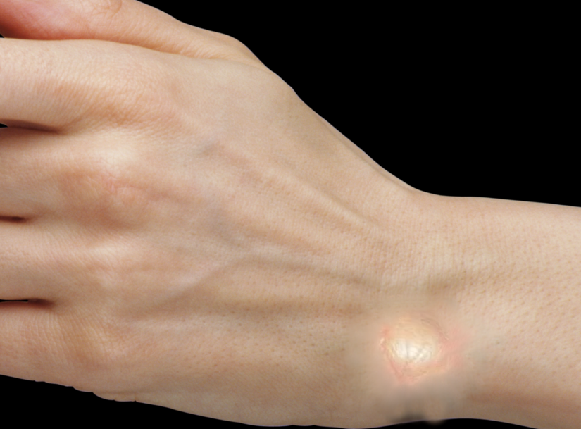 <p>Clinical Presentation of a Ganglion Cyst