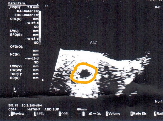 Final Transabdominal Ultrasound  at 8 weeks, shows 
gestational sac 7.3 mm with no fetus