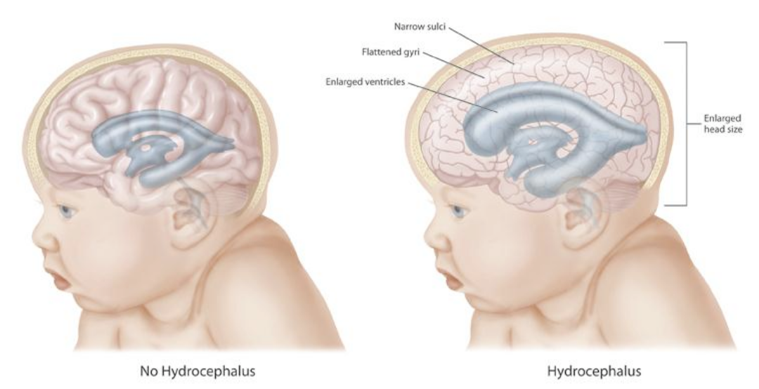 <p>Hydrocephalus.</p>