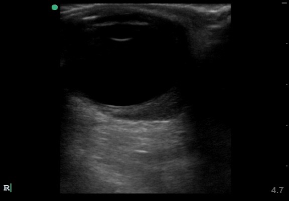 <p>Retrobulbar Hematoma on Ultrasound