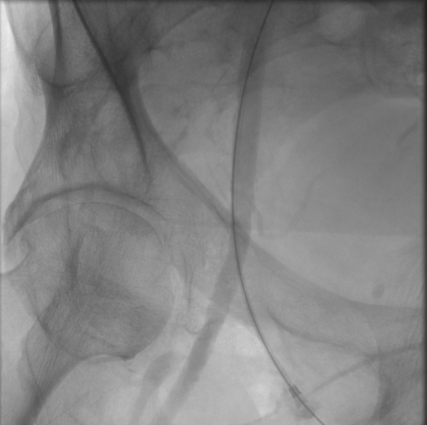 <p>Transfemoral Carotid Artery Stenting, Right Common Femoral Artery via Micropuncture