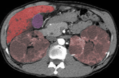 <p>Autosomal Polycystic Kidney Disease.</p>