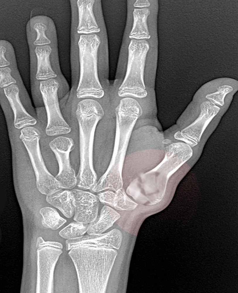 <p>Bennett Fracture.</p>