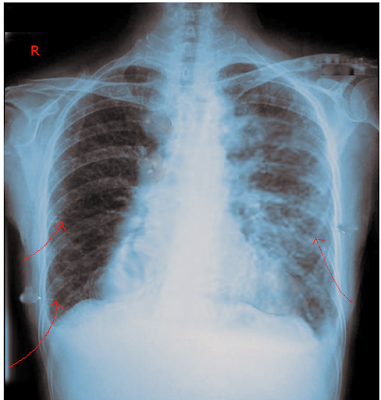 <p>Kerley Lines in Congestive Heart Failure.</p>