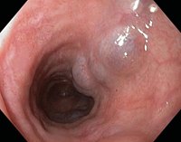 <p>Esophageal Varices