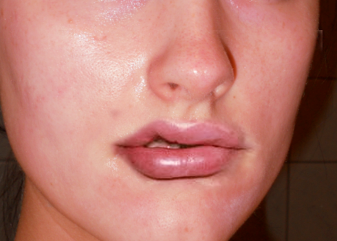 <p>Angioedema of the Lips