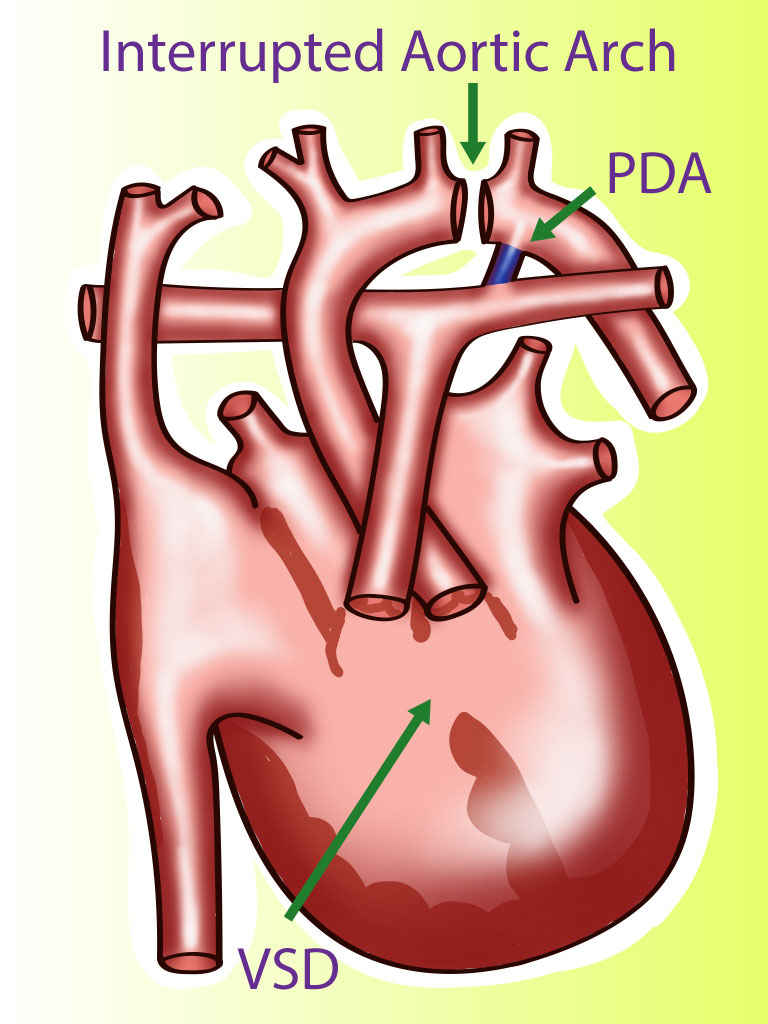 <p>Interrupted Aortic Arch.</p>