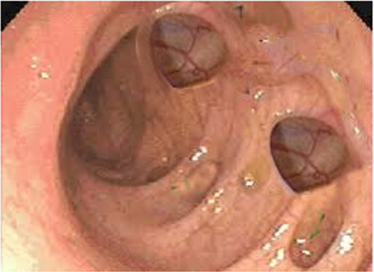 <p>Diverticulosis.</p>