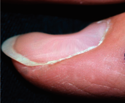 <p>Iron Deficiency: Spoon-Shaped Nail
