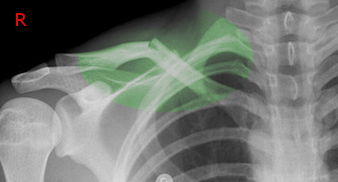 <p>Clavicle Fracture. Radiograph of clavicle fracture after a fall from a ladder.</p>