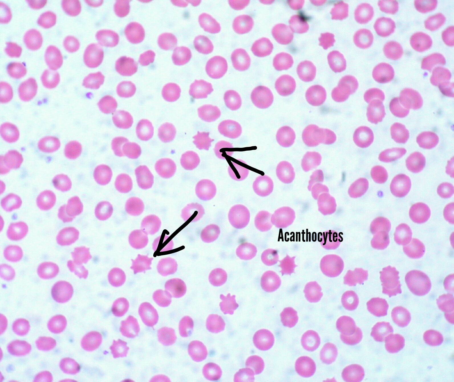 <p>Acanthyocytes