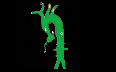 <p>Supravalvular Aortic Stenosis on Angiography