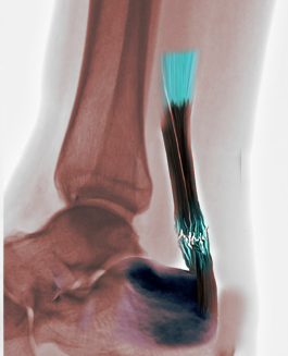 <p>Achilles Tendon Rupture.</p>