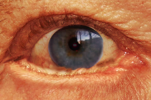 <p>Entropion of the Eye.</p>