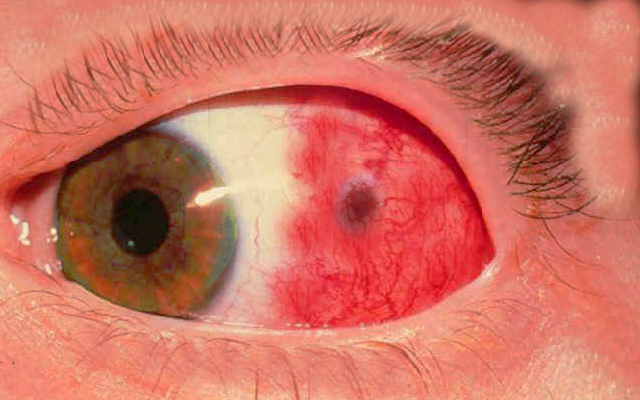 <p>Episcleritis of the Eye.</p>