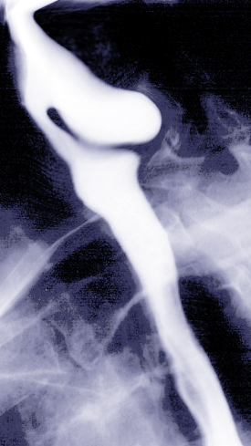 <p>Zenker Diverticulum.</p>
