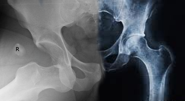 <p>Anterior Hip Dislocation, Radiograph.</p>
