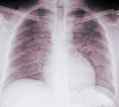 <p>Acute Respiratory Distress Syndrome.</p>