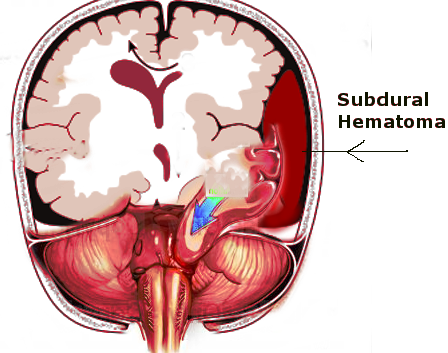 <p>Subdural Hematoma and Uncal Herniation