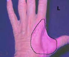 <p>Ulnar Nerve Compression.</p>