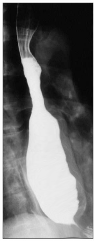 <p>Barium Swallow Study. Barium swallow showing achalasia.</p>