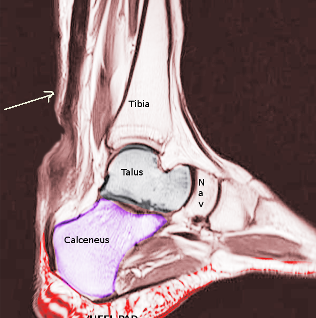 <p>Achilles Tendon Rupture.</p>