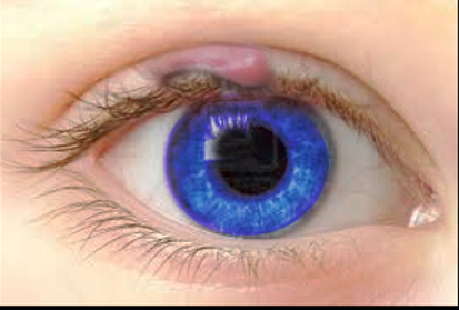 <p>Chalazion of the Upper Eyelid.</p>
