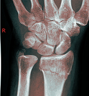 <p>Colles Fracture.</p>