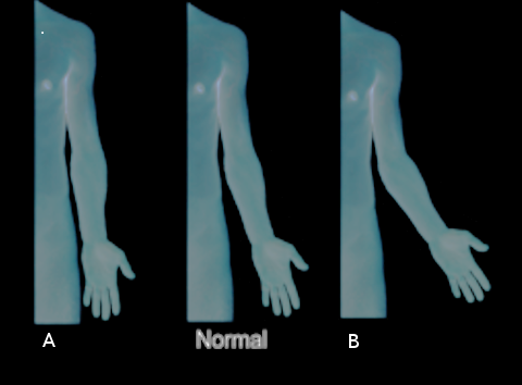 <p>Cubitus Varus and Valgus.</p>