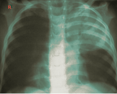 <p>Post Operative Atelectasis, Chest&nbsp;Radiograph.</p>
