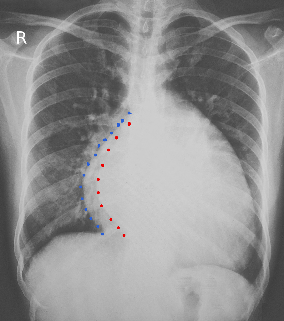 <p>Left Atrial Enlargement. Chest radiograph outlining an enlarged cardiac silhouette.&nbsp;</p>