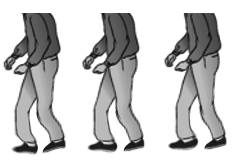 <p>Shuffling Gait Seen in Parkinson Disease