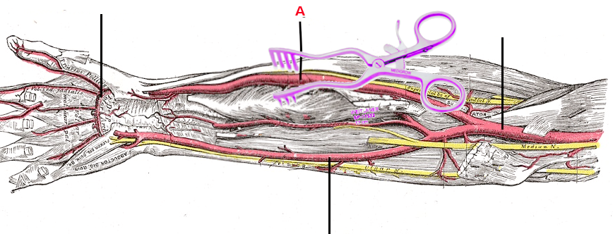 <p>Forearm&nbsp;Artery Dissection