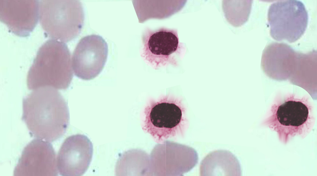 <p>Hairy-Cell Leukemia.</p>