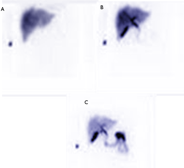 <p>HIDA scan in a patient with RUQ pain</p>