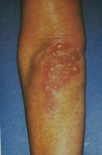 <p>Dermatitis Herpetiformis. Intact tense bullae on the elbow.</p>