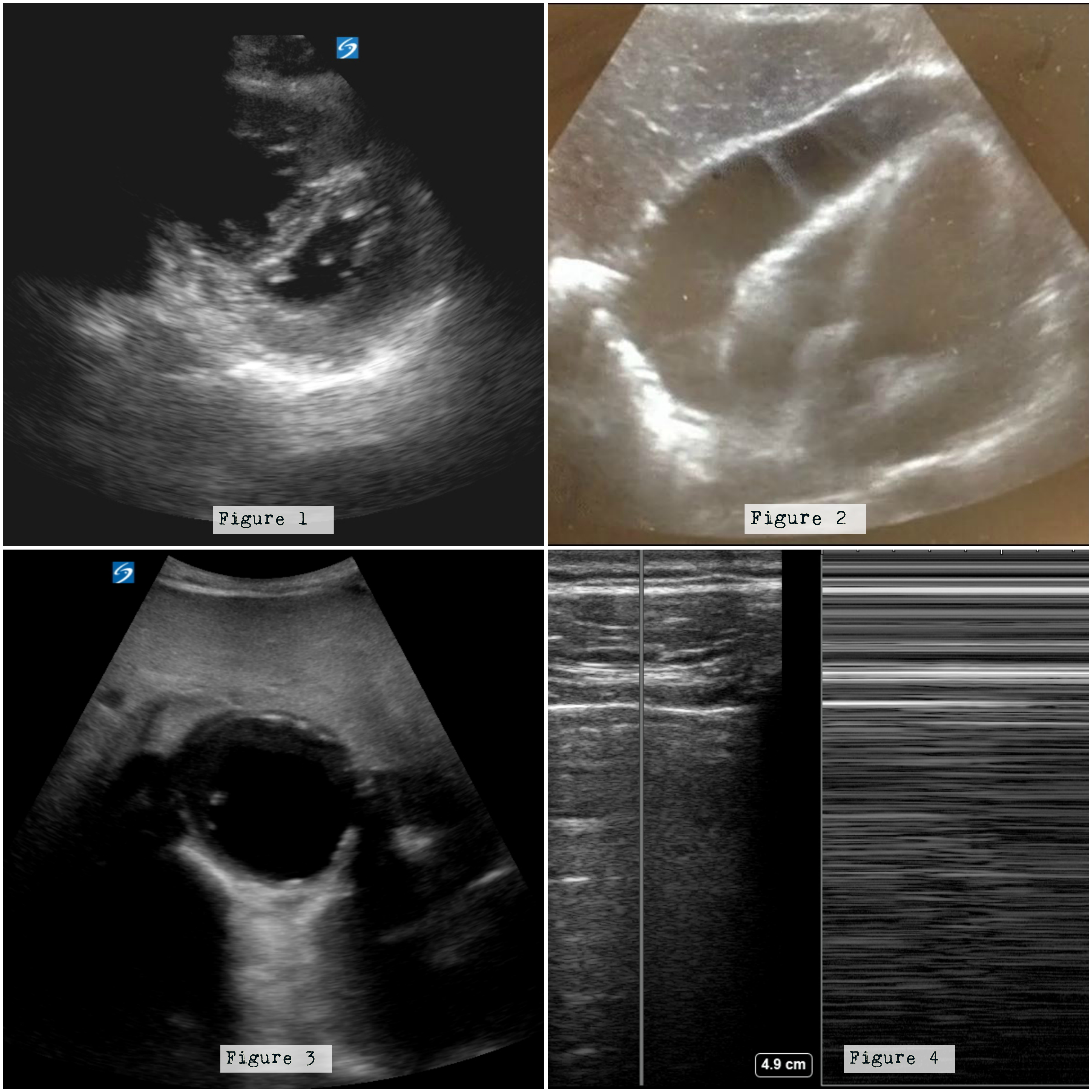 <p>Figure 1: Note the enlarged right ventricle displacing the septum into the left ventricle