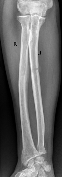 <p>Greenstick Fracture of the Ulna
