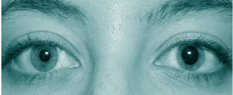 <p>Anisocoria.&nbsp;</p>