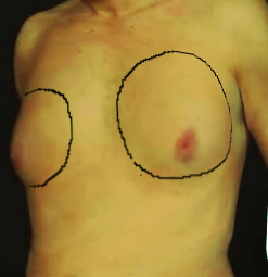 <p>Gynecomastia.</p>