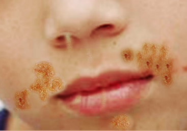 <p>Impetigo in a Child</p>