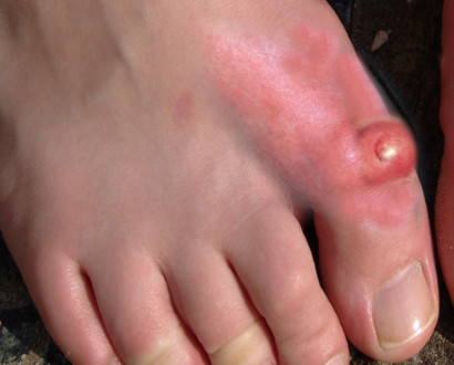 <p>Acute Gout Involving the First Metatarsophalangeal Joint