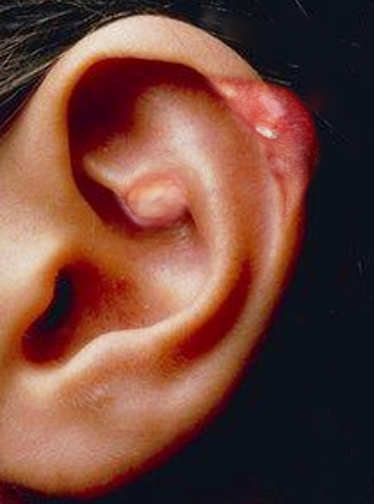 <p>Auricular Tophus in Chronic Gout