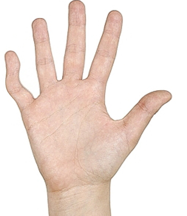 <p>Clinodactyly of the Little Finger.</p>