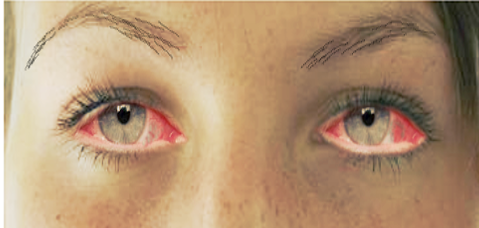 <p>Viral Conjunctivitis.</p>