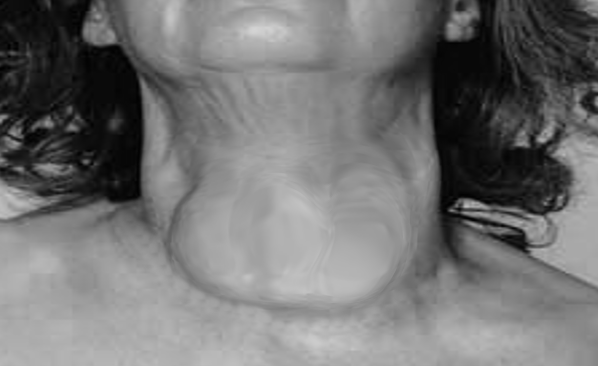 <p>Goiter in a Woman. Clinical photograph showing anterior neck enlargement consistent with thyroid gland hypertrophy.</p>
