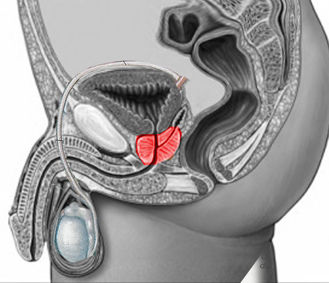 <p>The Prostate Gland.</p>