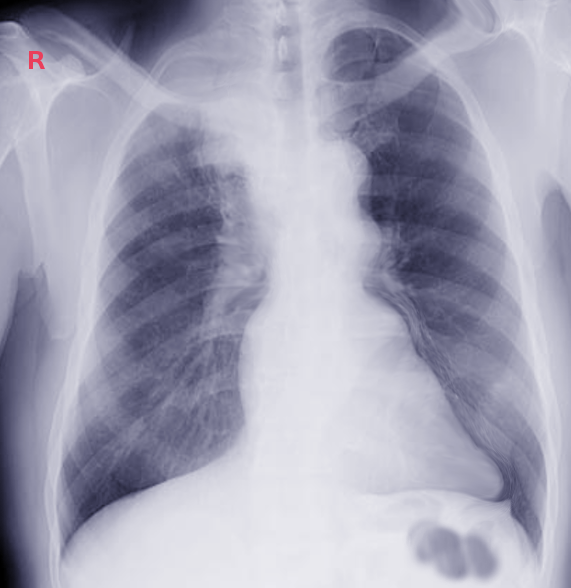 <p>Pancoast Tumor